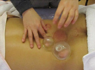 Cupping therapy